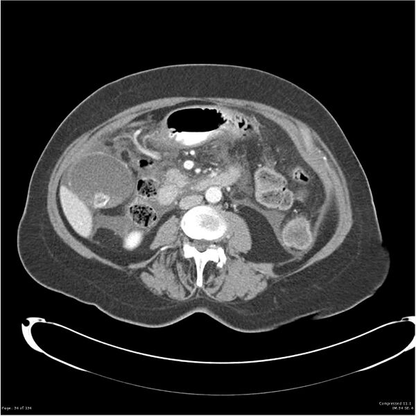 File:Acute pancreatitis (Radiopaedia 19136-19117 Axial C+ portal venous phase 21).jpg