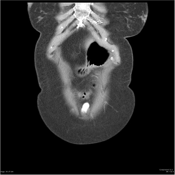 File:Acute pancreatitis (Radiopaedia 19136-19117 Coronal C+ portal venous phase 1).jpg