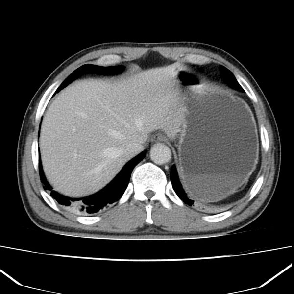 File:Acute pancreatitis (Radiopaedia 22572-22596 Axial C+ portal venous phase 11).jpg