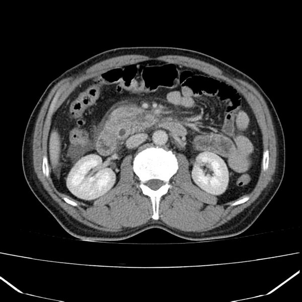 File:Acute pancreatitis (Radiopaedia 22572-22596 Axial C+ portal venous phase 31).jpg
