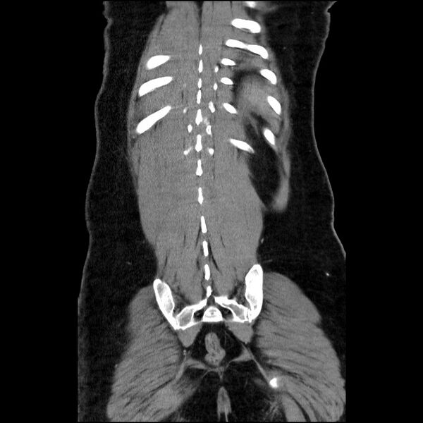 File:Acute pancreatitis (Radiopaedia 69236-79012 Coronal C+ portal venous phase 20).jpg