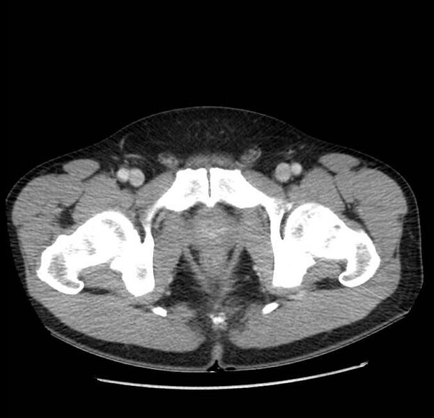 File:Acute pancreatitis - Balthazar E (Radiopaedia 23080-23110 Axial C+ portal venous phase 73).jpg