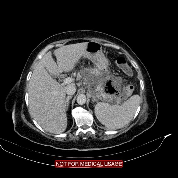 File:Acute pancreatitis with infected necrosis (Radiopaedia 26454-26585 Axial C+ delayed 7).jpg