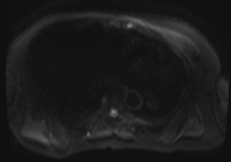 File:Acute portal vein thrombosis (Radiopaedia 73198-83925 Axial DWI 1).jpg