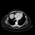 Acute pyelonephritis (Radiopaedia 25657-25837 Axial renal parenchymal phase 6).jpg