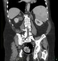 Acute renal failure post IV contrast injection- CT findings (Radiopaedia 47815-52559 Coronal C+ portal venous phase 24).jpg