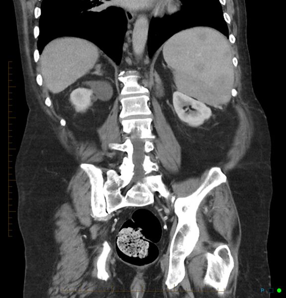 File:Acute renal failure post IV contrast injection- CT findings (Radiopaedia 47815-52559 Coronal C+ portal venous phase 24).jpg
