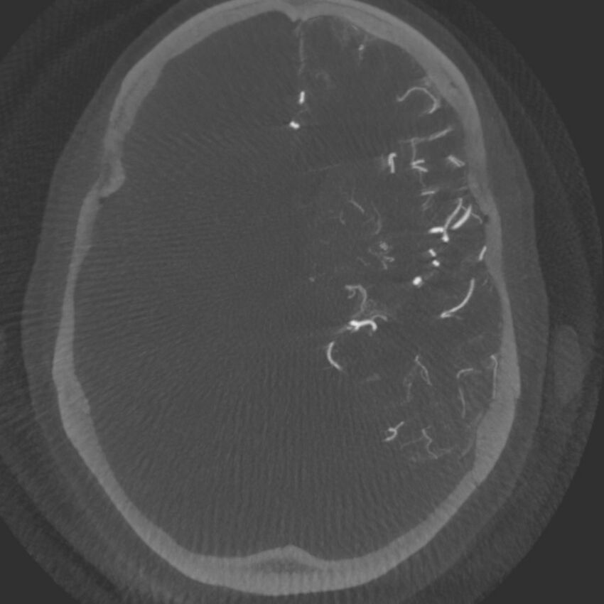 Acute subarachnoid hemorrhage and accessory anterior cerebral artery (Radiopaedia 69231-79010 C 29).jpg