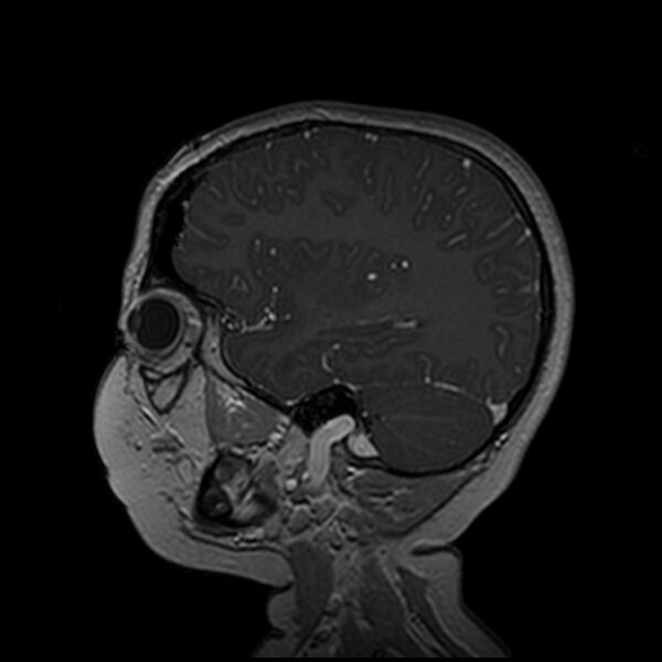File:Adamantinomatous craniopharyngioma (Radiopaedia 77407-89529 H 34).jpg