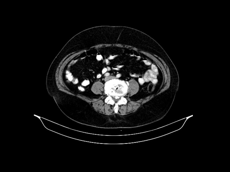 File:Adenocarcinoma of pancreas with hepatic metastasis (Radiopaedia 64332-73122 Axial C+ portal venous phase 67).jpg