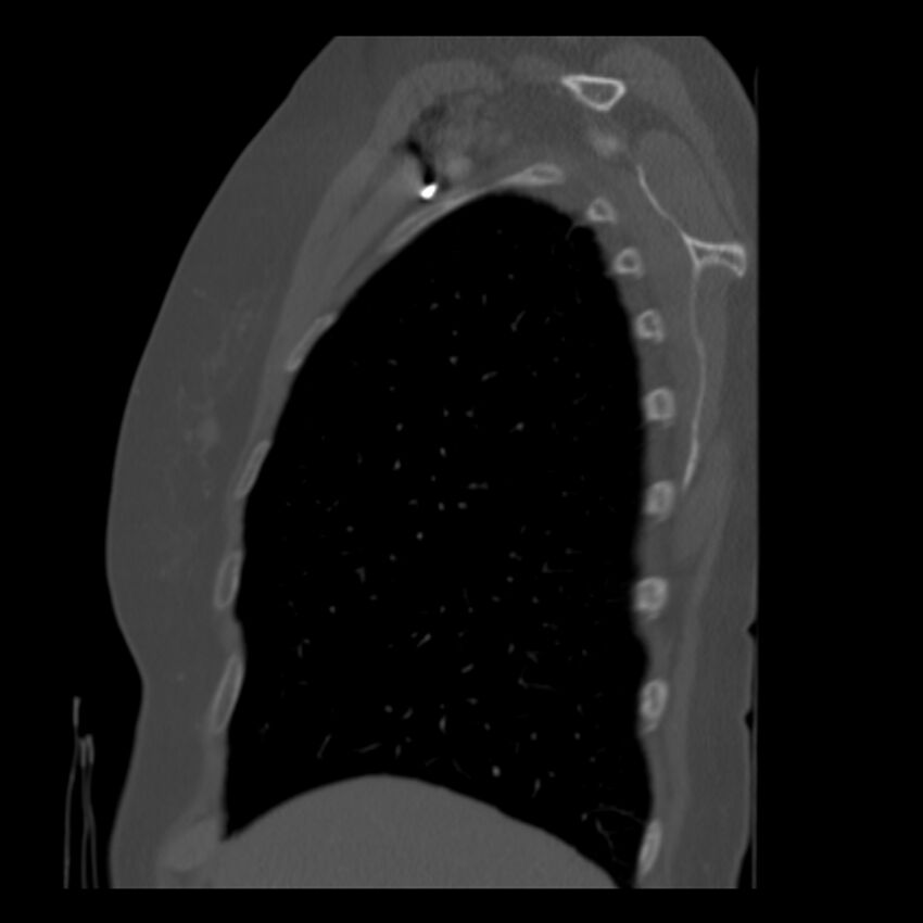 Adenocarcinoma of the lung (Radiopaedia 41015-43755 Sagittal bone window 13).jpg