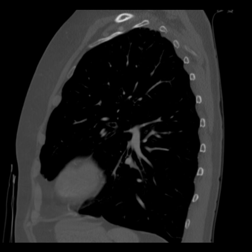 Adenocarcinoma of the lung (Radiopaedia 41015-43755 Sagittal bone window 75).jpg
