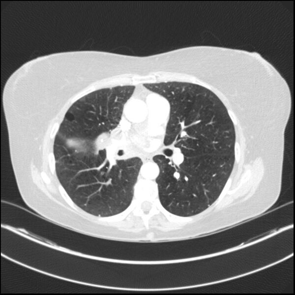 File:Adenocarcinoma of the lung (Radiopaedia 44205-47803 Axial lung window 47).jpg