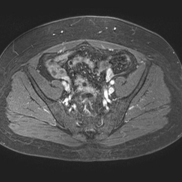 File:Adenomyoma of the uterus (Radiopaedia 9871-10439 Axial T1 C+ fat sat 19).jpg