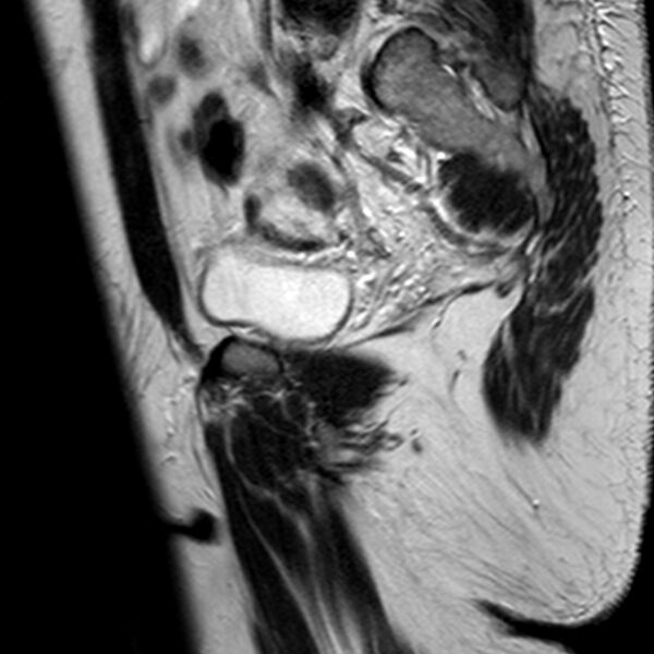 File:Adenomyoma of the uterus (Radiopaedia 9871-10439 Sagittal T2 20).jpg
