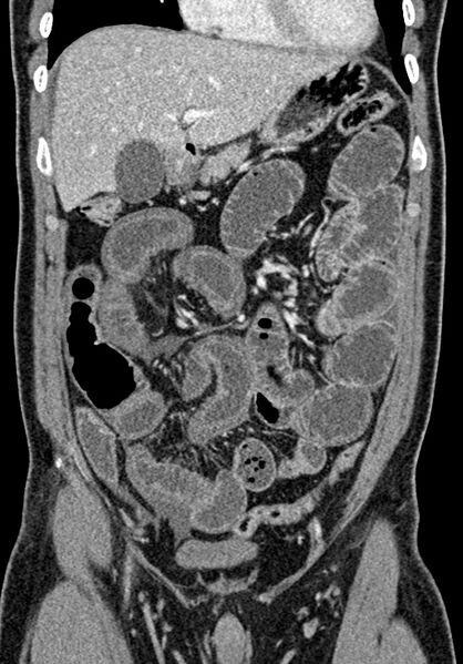 File:Adhesional small bowel obstruction (Radiopaedia 58900-66131 Coronal C+ portal venous phase 107).jpg