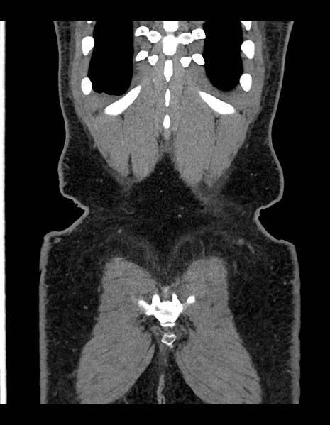 File:Adrenal myelolipoma - bilateral (Radiopaedia 74805-85810 Coronal C+ portal venous phase 57).jpg