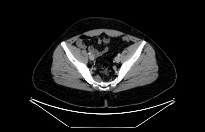 File:Adrenocortical carcinoma (Radiopaedia 80134-93438 Axial C+ portal venous phase 108).jpg