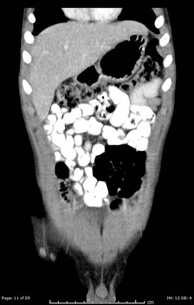 File:Agenesis of the gallbladder (Radiopaedia 55454-61905 A 11).jpg