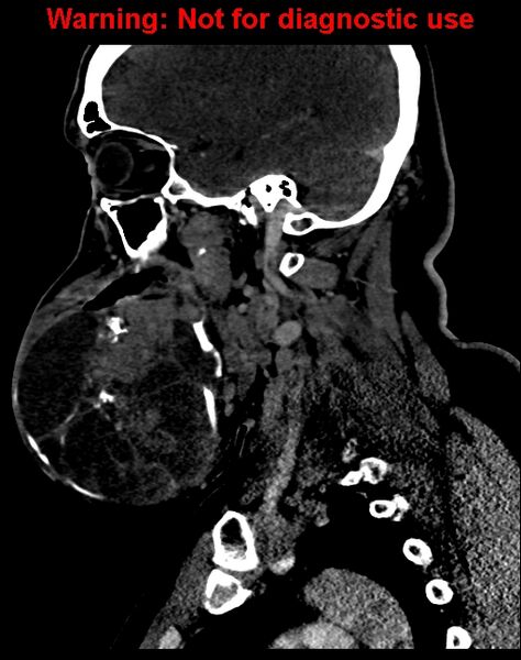 File:Ameloblastoma (Radiopaedia 33126-34164 F 26).jpg