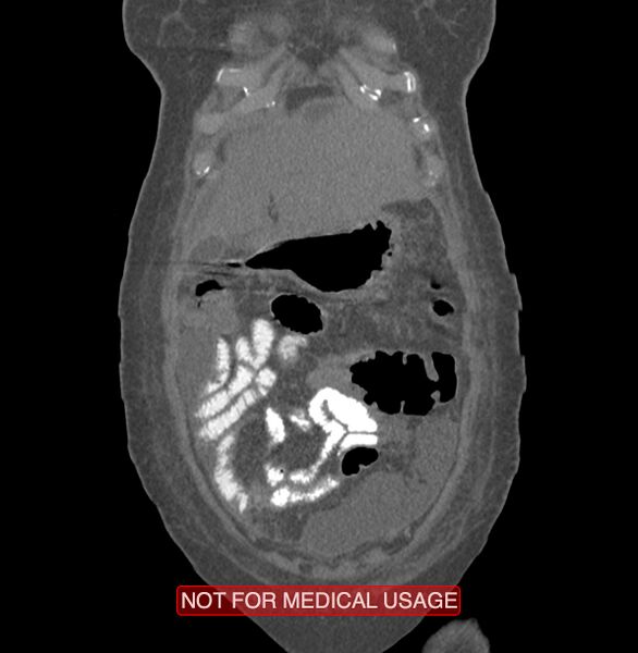 File:Amoebic enterocolitis with liver abscess (Radiopaedia 35100-36609 B 15).jpg