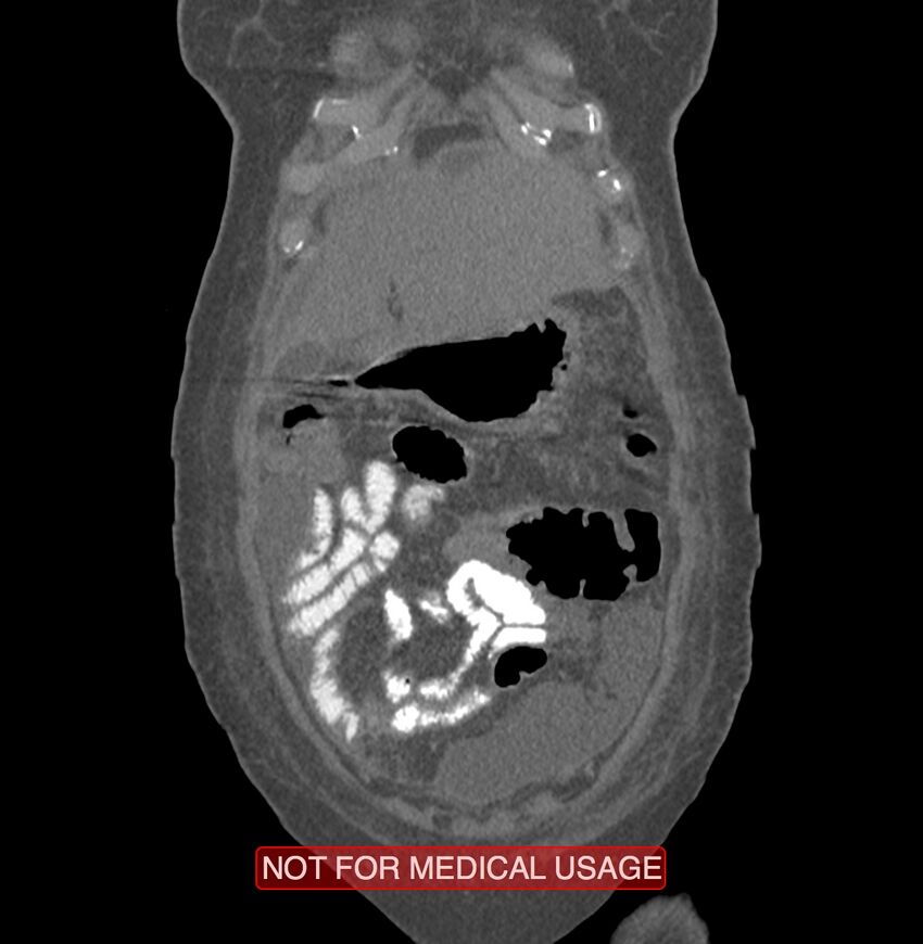 Amoebic enterocolitis with liver abscess (Radiopaedia 35100-36609 B 15).jpg
