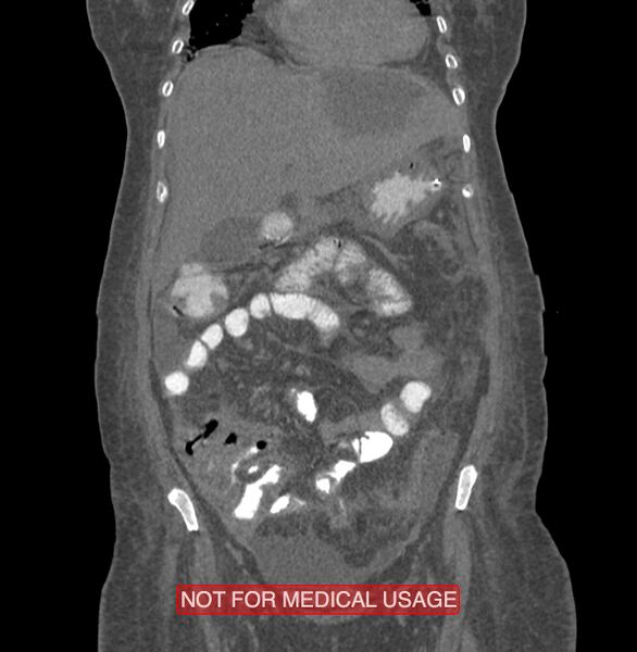 File:Amoebic enterocolitis with liver abscess (Radiopaedia 35100-36609 B 53).jpg