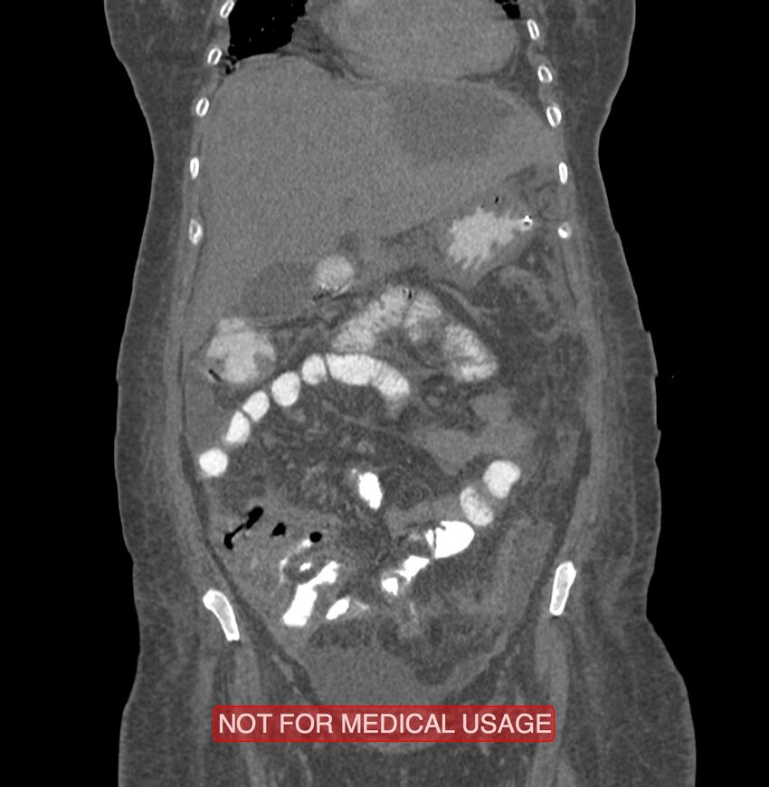 Amoebic enterocolitis with liver abscess (Radiopaedia 35100-36609 B 53).jpg