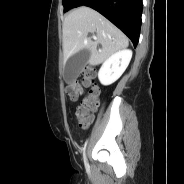 File:Ampullary tumor (Radiopaedia 22787-22816 D 16).jpg