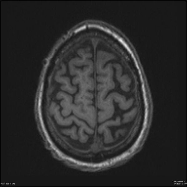 File:Anaplastic meningioma with recurrence (Radiopaedia 34452-35788 Axial T1 121).jpg