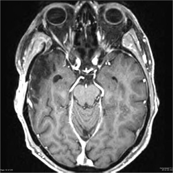 File:Anaplastic meningioma with recurrence (Radiopaedia 34452-35788 Axial T1 C+ 52).jpg