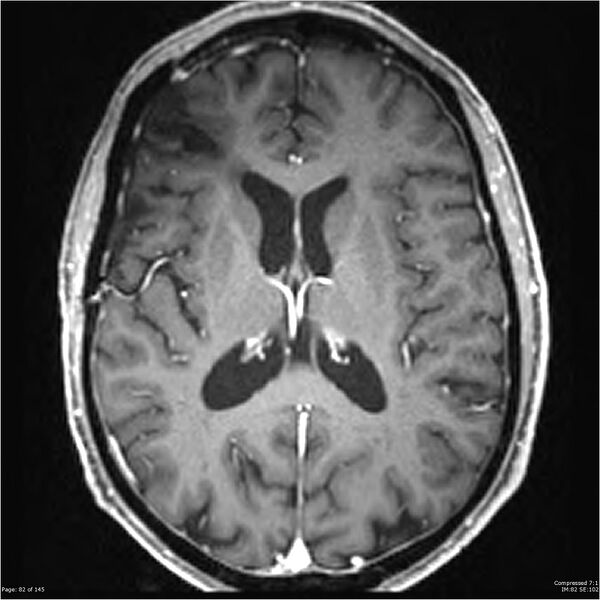 File:Anaplastic meningioma with recurrence (Radiopaedia 34452-35788 Axial T1 C+ 82).jpg