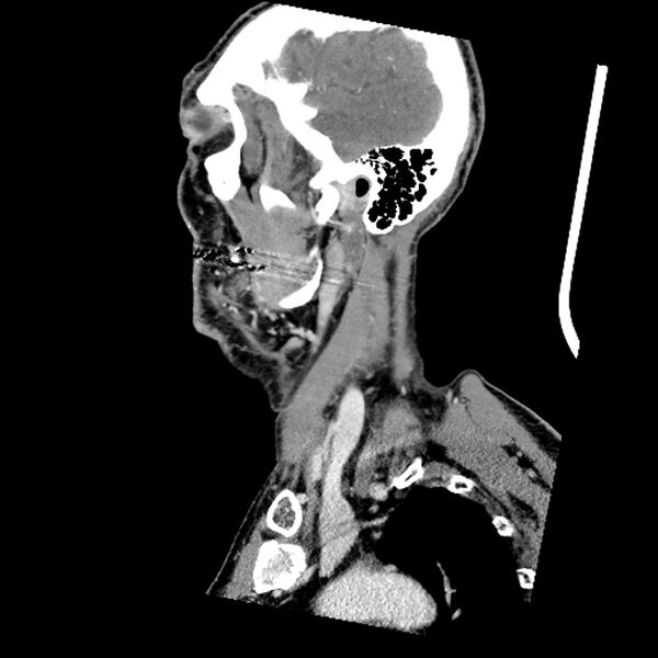 File:Anaplastic thyroid carcinoma (Radiopaedia 79087-92034 C 73).jpg