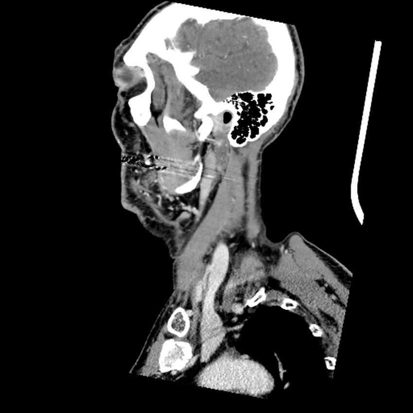 Anaplastic thyroid carcinoma (Radiopaedia 79087-92034 C 73).jpg