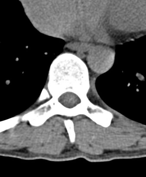 File:Aneurysmal bone cyst T11 (Radiopaedia 29294-29721 Axial non-contrast 22).jpg