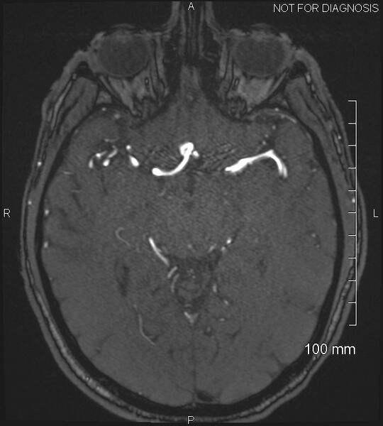 File:Anterior cerebral artery aneurysm (Radiopaedia 80683-94127 Axial MRA 105).jpg