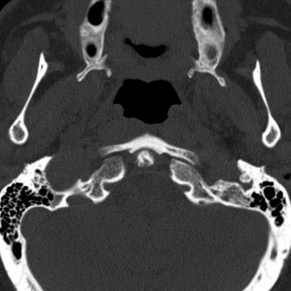 File:Anterior cervical postdiscectomy arthrodesis (Radiopaedia 32678-33646 Axial bone window 6).jpg