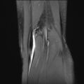 Anterior cruciate ligament tear - pediatric (Radiopaedia 62152-70260 Coronal PD fat sat 1).jpg