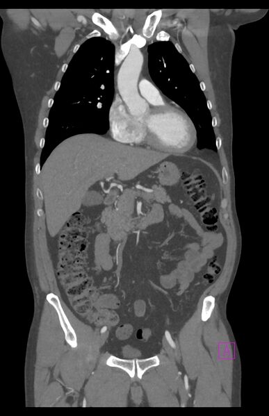 File:Aortectomy and axillary-bifemoral bypass (Radiopaedia 28303-28545 C 38).jpg