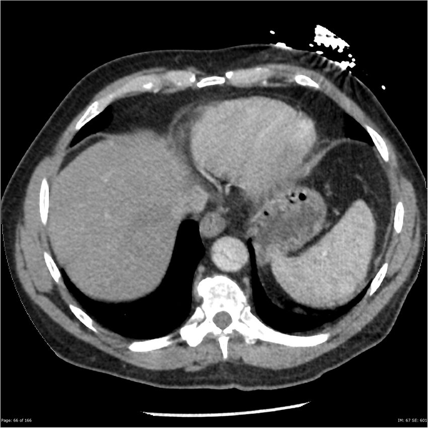 Aortic dissection- Stanford A (Radiopaedia 37759-39664 A 57).jpg
