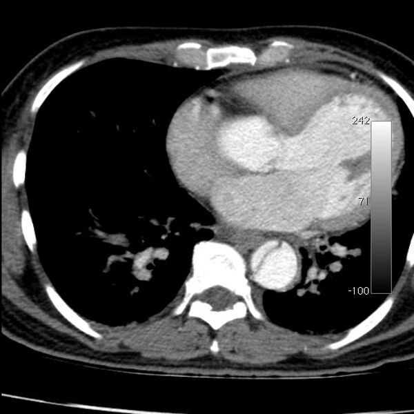 File:Aortic dissection - Stanford type A (Radiopaedia 29247-29659 A 51).jpg