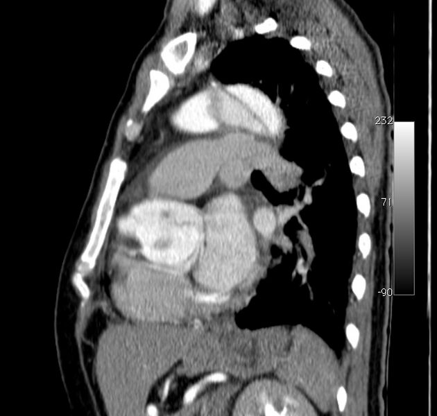 File:Aortic dissection - Stanford type A (Radiopaedia 29247-29659 C 19).jpg