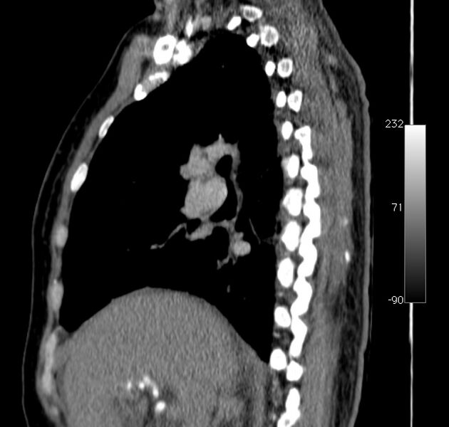 File:Aortic dissection - Stanford type A (Radiopaedia 29247-29659 C 39).jpg