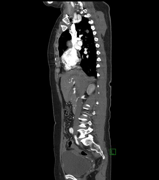 File:Aortic dissection with renal ischemia (Radiopaedia 76573-88338 D 9).jpg