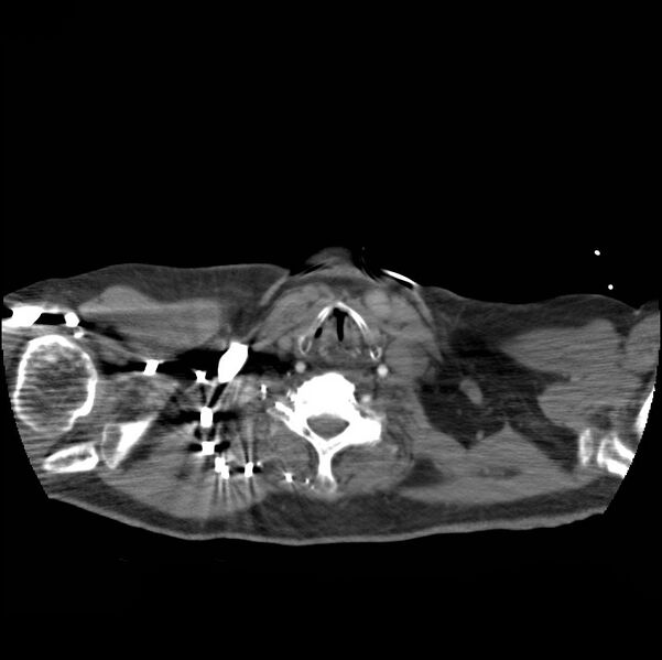 File:Aortic dissection with rupture into pericardium (Radiopaedia 12384-12647 A 1).jpg