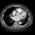 Aorto-coronary bypass graft aneurysms (Radiopaedia 40562-43157 A 73).png