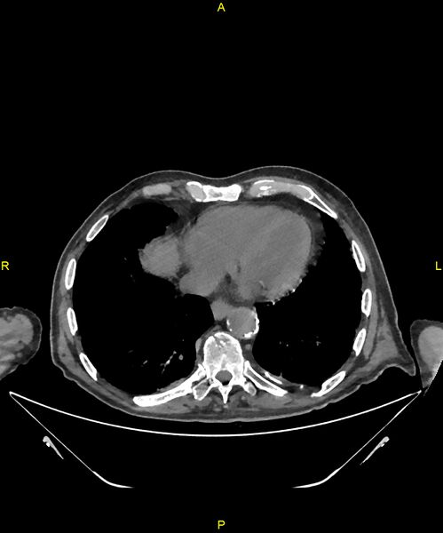File:Aortoenteric fistula (Radiopaedia 84308-99603 Axial non-contrast 1).jpg