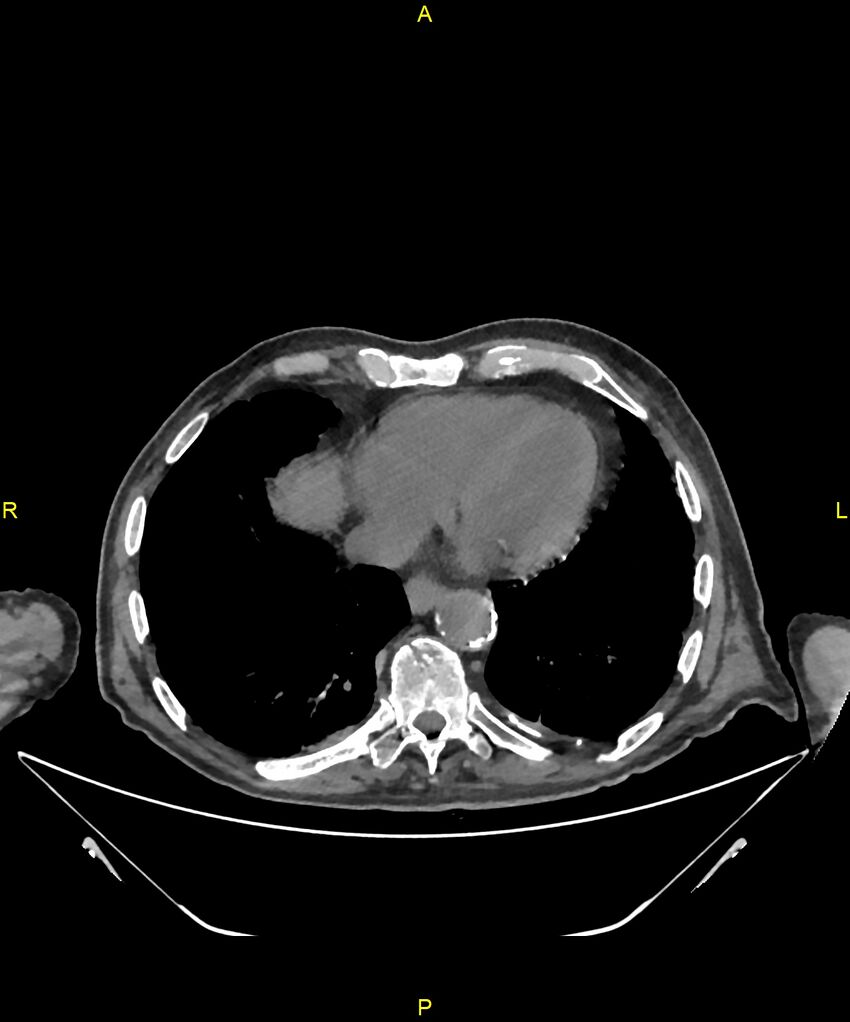 Aortoenteric fistula (Radiopaedia 84308-99603 Axial non-contrast 1).jpg