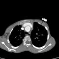 Aortopulmonary window, interrupted aortic arch and large PDA giving the descending aorta (Radiopaedia 35573-37074 B 23).jpg