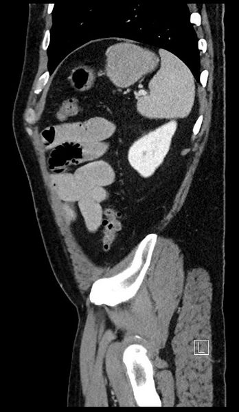 File:Appendiceal diverticulitis (Radiopaedia 61802-69916 C 31).jpg